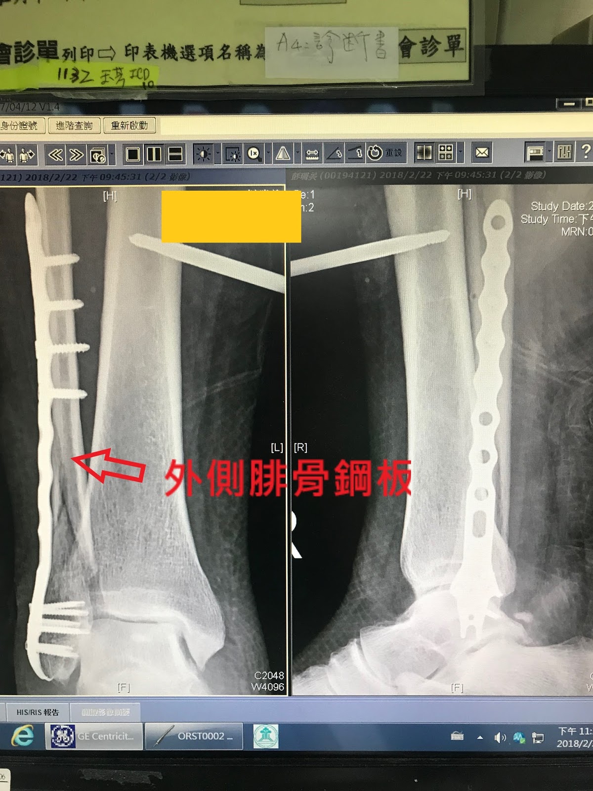 骨科李宜軒醫師 脛骨平台骨折tibia Plateau Fracture 脛骨近端骨折proximal Tibia Fracture