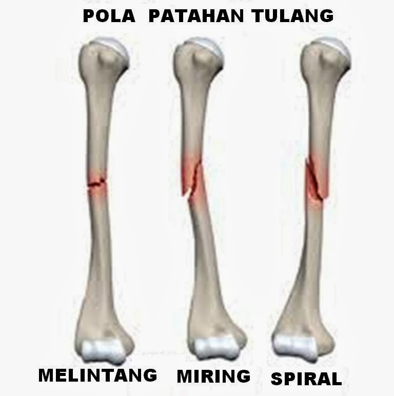 PENGOBATAN PATAH TULANG: Februari 2014