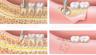 Một số lưu ý về quá trình mọc răng khôn