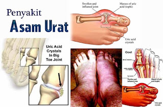 Cara Hindari Asam Urat, Obat Nyeri Asam Urat Di Apotik, Www.Obat Asam Urat Alami.Com, Asam Urat Puasa, Bagaimana Cara Mencegah Penyakit Asam Urat, Bolehkah Penderita Asam Urat Minum Kopi, Daun Sirsak Untuk Asam Urat Dan Rematik, Obat Sakit Asam Urat Yg Ampuh, Cara Pengobatan Asam Urat Dengan Jeruk Nipis, Asam Urat Hasil Pemecahan Protein, Www.Penyebab Asam Urat Tinggi, Asam Urat Normal Nya Berapa, Alpukat Pantangan Asam Urat, Makanan Yang Bisa Menurunkan Asam Urat Dan Kolesterol, Cara Ampuh Mengobati Asam Urat, Asam Urat Pada Wanita, Obat Herbal Asam Urat Adalah, Edamame Menyebabkan Asam Urat, Menurunkan Asam Urat Herbal, Herbal Buat Asam Urat, Penderita Asam Urat Boleh Minum Susu Kedelai, Efek Bila Asam Urat Tinggi, Obat Herbal Untuk Penderita Asam Urat Tinggi, Cara Menghilangkan Rasa Nyeri Akibat Asam Urat, Diet Rendah Asam Urat, Obat Asam Urat Yang Parah, Bengkak Sakit Asam Urat, Asam Urat Telapak Kaki Panas, Apakah Asam Urat Boleh Minum Es, Asam Urat Jamu 