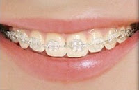 ortodontia estética