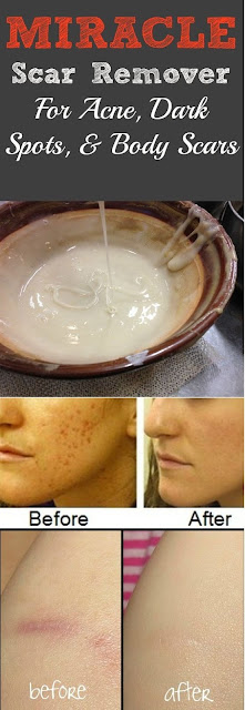 MIRACLE HOMEMADE SCAR REMOVER FOR ACNE AND ALL KINDS OF DARK SPOTS