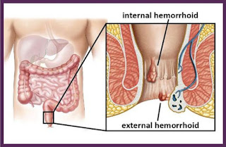 Ramuan Alami Mengatasi Wasir, Pengobatan Ambeyen Ala Hembing, Cara Mengatasi Ambeien Atau Wasir Yang Parah, Gejala Wasir Apa Saja, Obat Salep Ambeien Ampuh, Obat Wasir Di Penajam, Pengobatan Wasir Akut, Jual Obat Ambeien Di Lahomi, Mengobati Ambeien Pada Wanita Hamil, Klinik Pengobatan Ambeien Atau Wasir Di Jogja, Jual Obat Ambeien Di Jawa, Ambeien Itu Karena Apa, Mengobati Wasir Atau Ambeien Parah, Pengobatan Ambeien Atau Wasir Tanpa Operasi Di Bekasi, Cara Mengatasi Wasir Atau Ambeien Sesudah Melahirkan, Obat Paling Ampuh Menyembuhkan Wasir Atau Ambeien, Pengobatan Alternatif Ambeien Di Jakarta, Cara Mengatasi Ambeien Atau Wasir Dengan Cara Tradisional, Cara Mengobati Ambeien Atau Wasir Stadium 2, Obat Wasir Atau Ambeien Ampuh Apotik, Gejala Wasir, Cara Mengobati Ambeyen Dengan Herbal, Obat Ambeien Salep, Bagaimana Mengatasi Wasir Atau Ambeien Pada Ibu Hamil, Menyembuhkan Ambeien Atau Wasir Secara Tradisional 