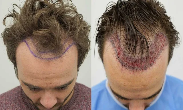 HAIR TRANSPLANT BEFORE AND AFTER