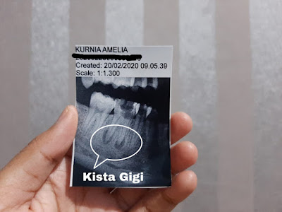 Biaya operasi kista gigi