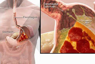 Treatment for Gastroesophageal reflux disease