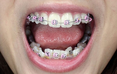 Kỹ thuật niềng răng khi mất răng hàm