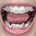 Kỹ thuật niềng răng khi mất răng hàm