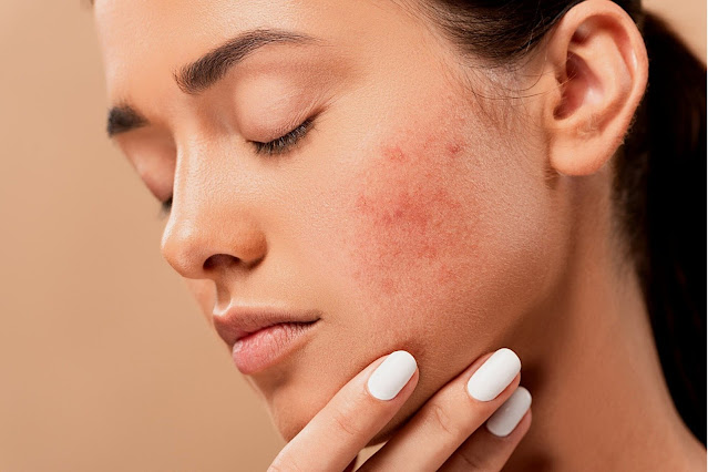 चेहरे पर मुँहासे का कारण,  लक्षण और घरेलू उपचार | Acne Facial Causes, Symptoms and Home Remedies