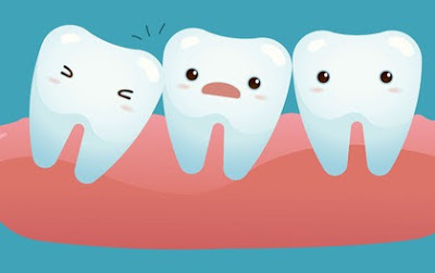 Nhổ răng khôn hàm trên giá bao nhiêu?