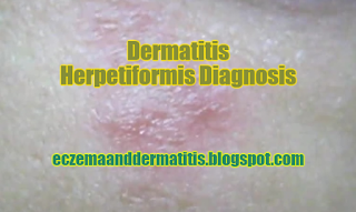 Dermatitis Herpetiformis Diagnosis