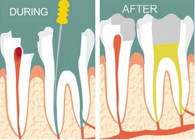 Tìm ra các chân răng bị lung lay và cách phòng ngừa-2