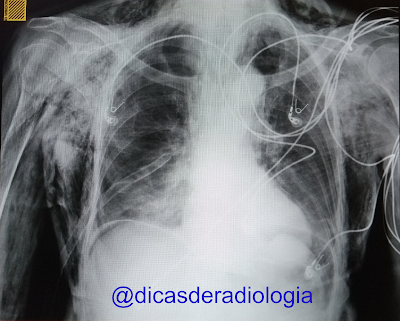 Exame raio x demonstrando Enfisema Subcutâneo, Exames de Imagem