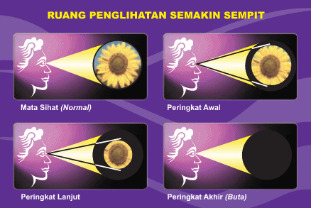 Jenis Dan Rawatan Glaukoma