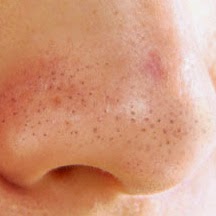 Cara Menghilangkan Komedo Terbuka (Blackhead)