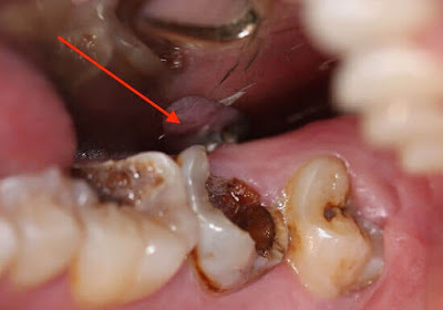 Răng cấm bị sâu có nên nhổ?
