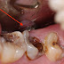Có nên nhổ bỏ răng cấm bị sâu?