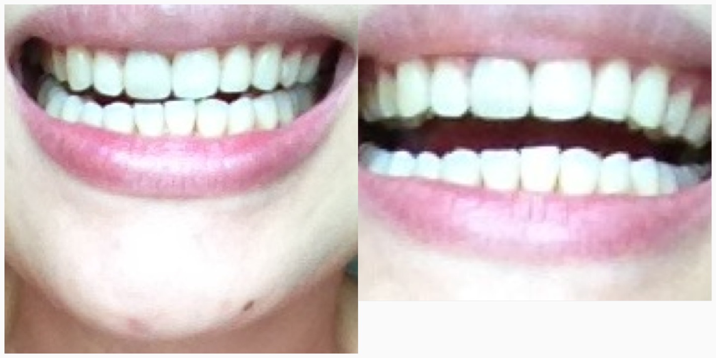  20&gt; Images For - Before And After Teeth Whitening With Baking Soda