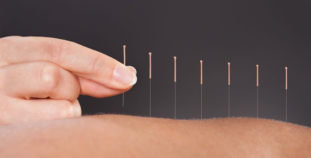Types of Acupuncture
