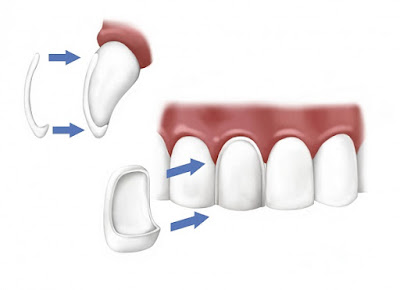 Các bước dán răng sứ không mài răng chuẩn 