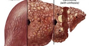 LEAFLET HEPATITIS  DUNIA KEPERAWATAN