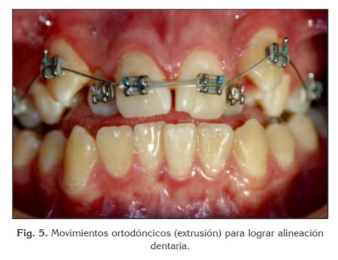 PDF: Ortodoncia y Periodoncia - Relación en el tratamiento