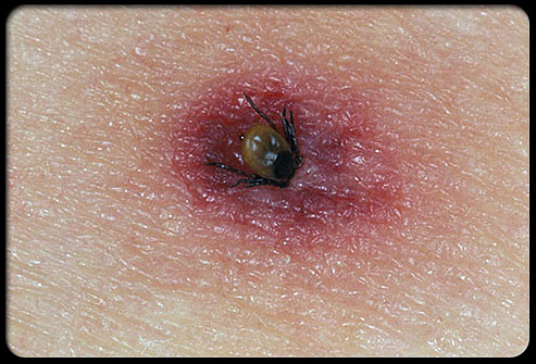 Lyme Disease Picture