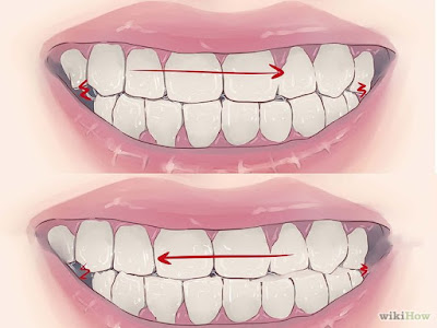 How to Stop Grinding Teeth at Night Step 1