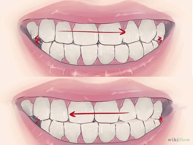 How to Stop Grinding Teeth at Night