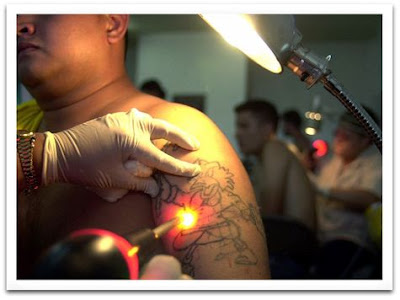 Laser Tattoo Removal