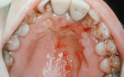 herpes simplex mouth. remedies for herpes is rub