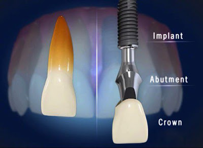 Quy trình trồng răng Implant