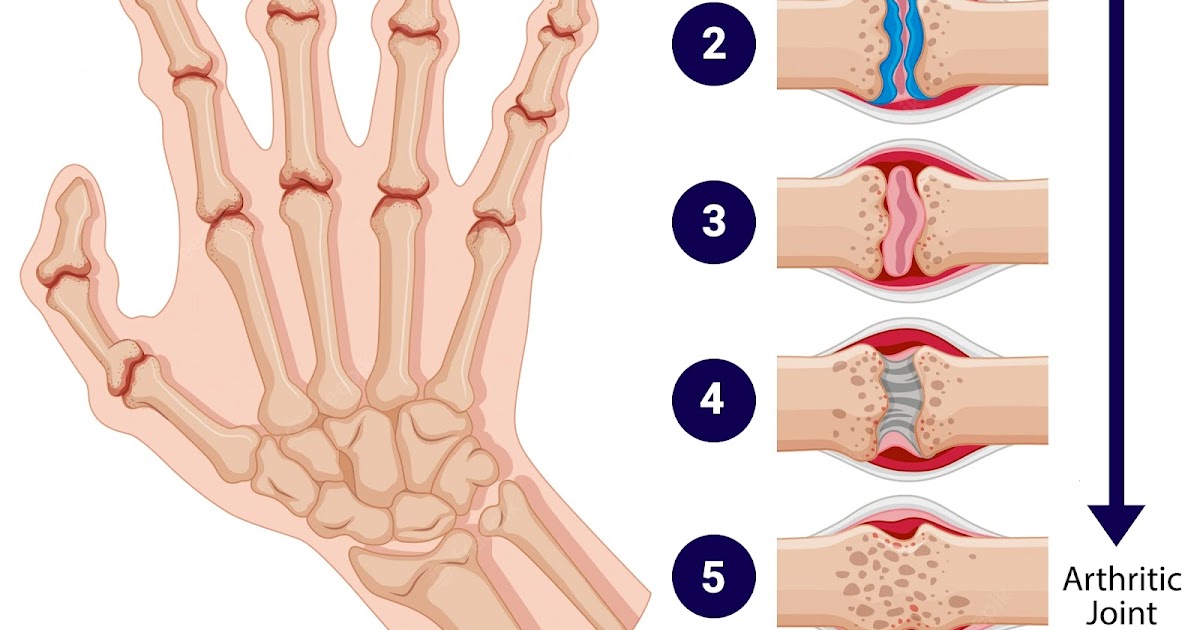 Rheumatoid Arthritis Treatment; Exploring the Aims of it