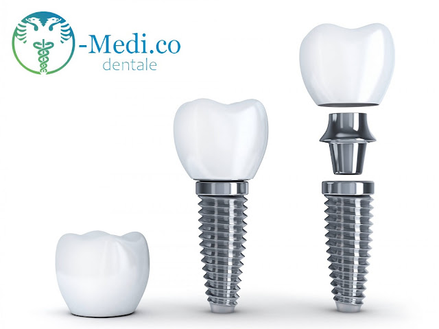 Una corona dentale in zirconio, un impianto dentale montato con il moncone e la corona e un impianto con moncone e la corona divisi