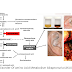 Disorder Of amino Acid Metabolism Alkaptonuria (AKU)