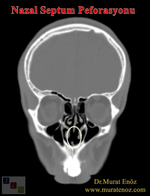 Nazal septum perforasyonun ameliyatının başarısı - Nazal septum perforasyonun çapı ameliyat başarısını olumsuz etkiliyor! - Burun septumundaki delik büyüdükçe ameliyatla tam kapanma oranı düşüyor - Nazal septum perforasyonu çapı - Burun duvarında delik olması