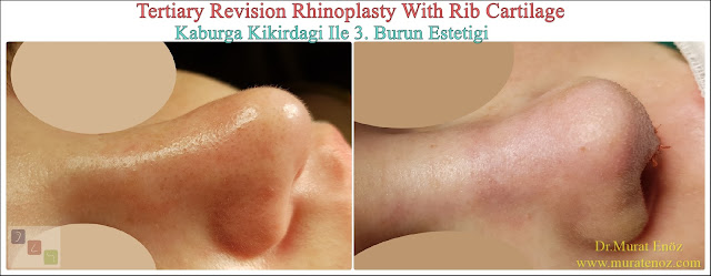 Revision nose aesthetic surgery - Revision nose job in Istanbul - Tertiary nose job in Turkey - - Tertiary rhinoplasty - Tertiary rhinoplasty challenges - Revision rhinoplasty using rib cartilage - Cost of Revision Rhinoplasty in Istanbul - Healing After Revision Rhinoplasty Operation - Revision Rhinoplasty in Istanbul -  Tertiary rhinoplasty using rib cartilage in Istanbul Turkey