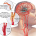Penyakit Stroke / Serangan Otak