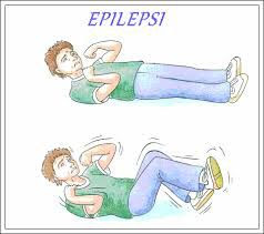 epilepsi