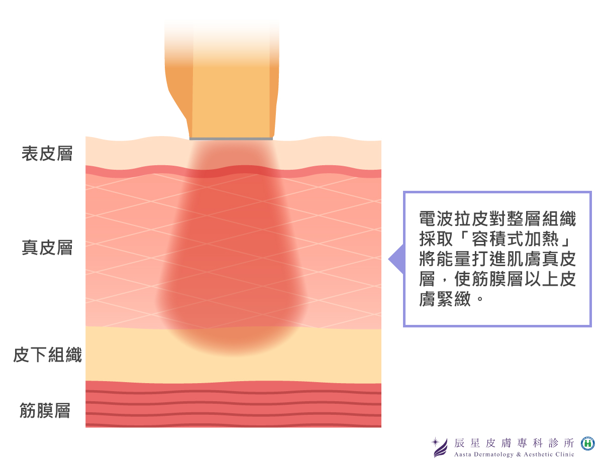 電波拉皮失敗