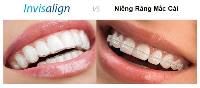 chi-phi-nieng-rang-invisalign