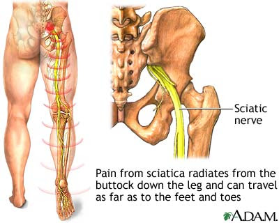 stretches for sciatica. Sciatica