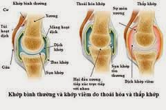 THOÁI HÓA KHỚP - Nỗi lo không chỉ của người cao tuổi