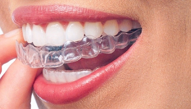 interesting facts about invisalign teeth straightening