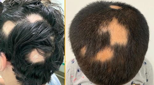  is a condition that causes hair to fall out in small patches [New Featured] Alopecia Areata & Hair Loss: Causes, symptoms, treatment
