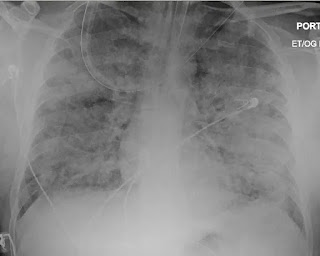 What Is Severe Acute Respiratory Syndrome (SARS)