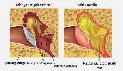 http://obatradangtelingapadaanak.blogspot.com/