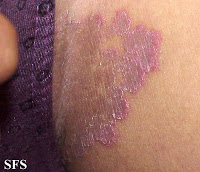 Treatment For Herpes Dermatitis : Genital Herpes Treatment Genital Herpes  Herpes Treatment 