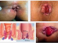 Cari Obat Ambeien Alami dan Manjur