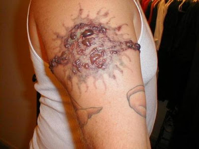 Tattoo Removal Procedure. Permanent Make Up Procedure